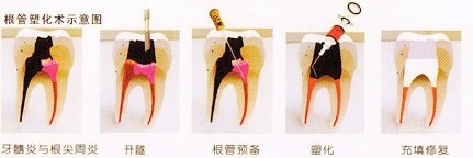 爱齿尔根管治疗