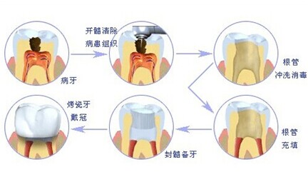 武汉根管治疗