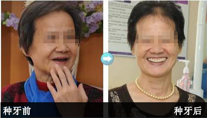 武汉爱齿尔口腔种植牙