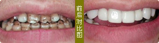 牙齿症状: 瓜子牙