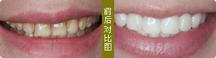 牙齿症状: 黑牙