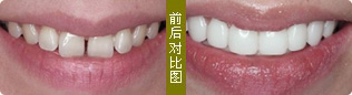 牙齿症状: 牙黄
