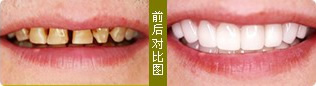 牙齿症状: 氟斑牙、个小牙