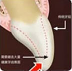 烤瓷牙备牙方案