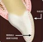 普通贴面备牙方案