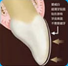 爱齿尔超薄牙贴面备牙方案