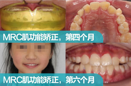 MRC肌功能矫正