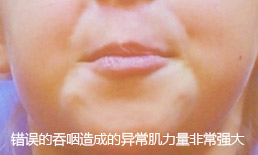 不正确的吞咽动作