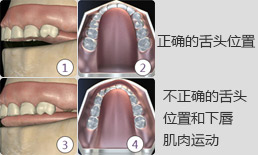 不正确的舌头位置和下唇肌肉运动